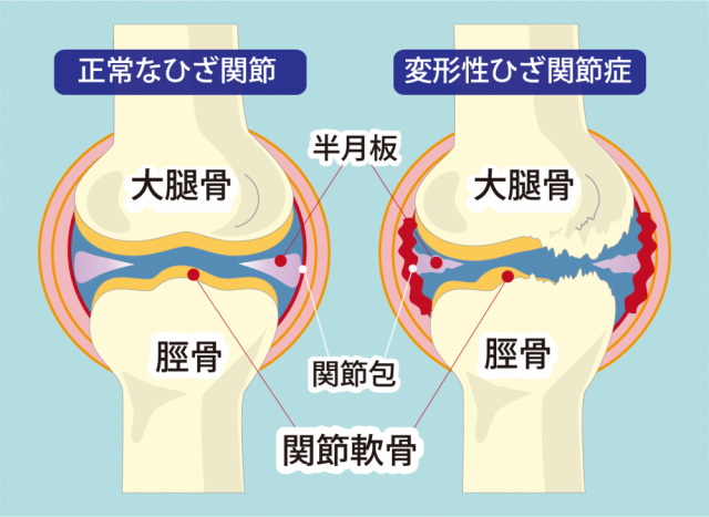 当院での変形性膝関節症の改善の際きをつけていること